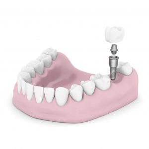 Dental implant diagram