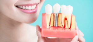 Dental Implant Diagram